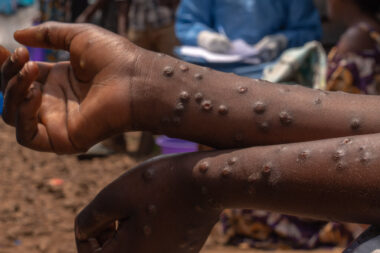 Mayotte - un pompier testé positif au Mpox, la caserne désinfectée par précaution