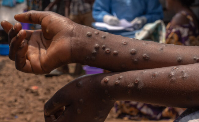Mayotte - un pompier testé positif au Mpox, la caserne désinfectée par précaution
