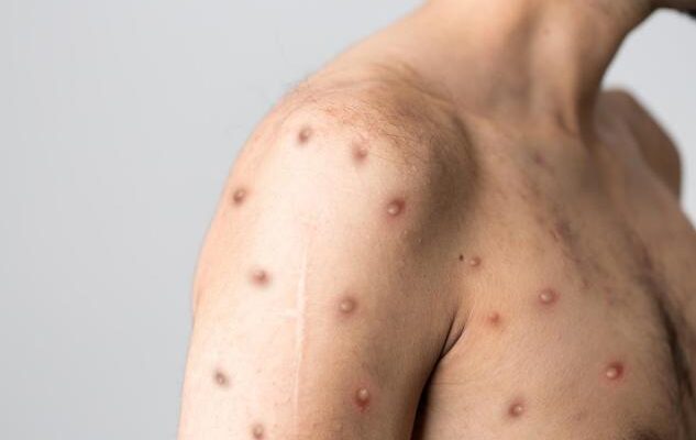 Mpox : deux nouveaux cas confirmés à La Réunion, l’ARS renforce la vigilance
