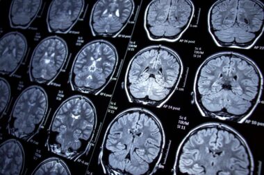 Parkinson - des chercheurs identifient le réseau cérébral clé et ouvrent la voie à un traitement plus précis