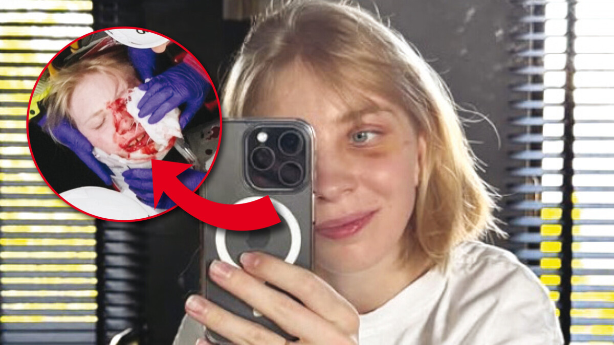 冬季オリンピックで重傷を負い、眼窩にチタンプレートが入っているにもかかわらず、カミラ・セリエは競技生活の再開を望んでいる。（DR、インタビュー）