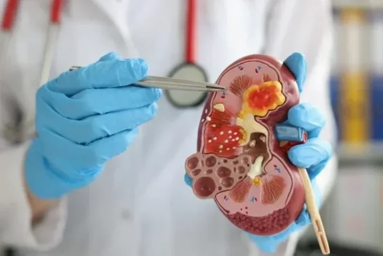 Cancer du rein : des symptômes discrets qui retardent le diagnostic