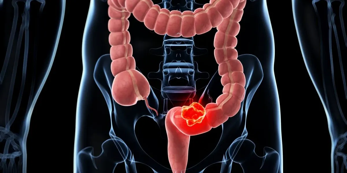 结直肠癌筛查：检测结果呈阳性，然后……等待