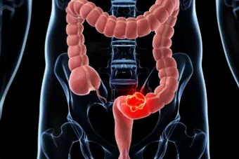 大腸がん検診：陽性反応が出たら…あとは待つだけ — 写真