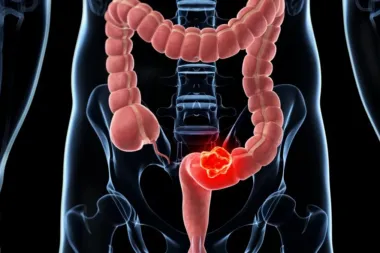 Colorectal cancer screening: the positive test, and then… the wait