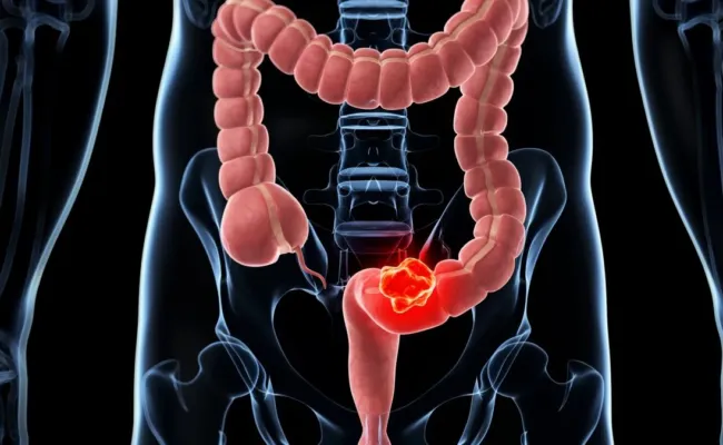 Dépistage du cancer colorectal : le test positif, et après… l’attente