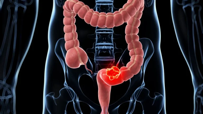 Dépistage du cancer colorectal : le test positif, et après… l’attente — photo