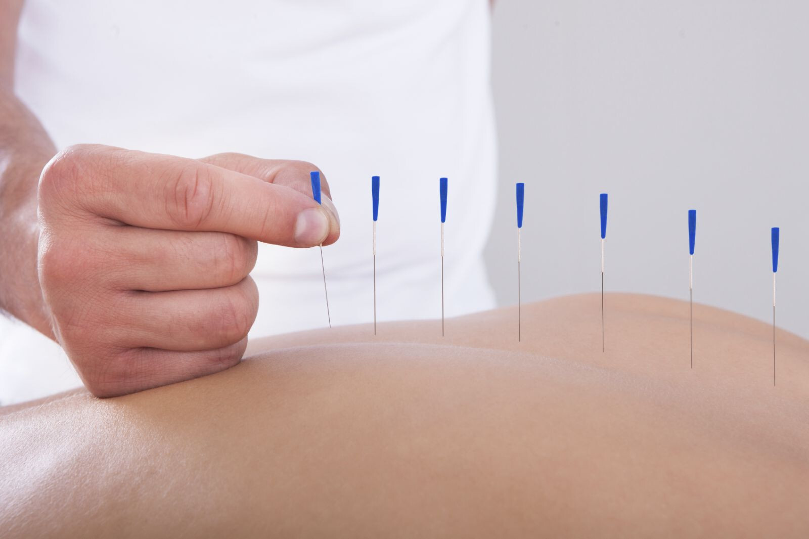 Carpal tunnel syndrome: acupuncture seeks its place in the fight against pain