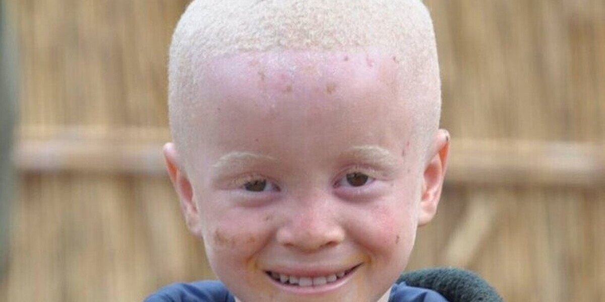 Madagascar : un enfant albinos de 2 ans sauvé après son enlèvement