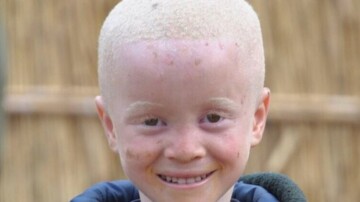 Madagascar : un enfant albinos de 2 ans sauvé après son enlèvement
