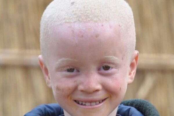 Madagascar : un enfant albinos de 2 ans sauvé après son enlèvement