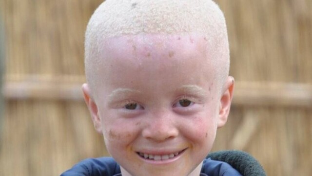 Madagascar : un enfant albinos de 2 ans sauvé après son enlèvement