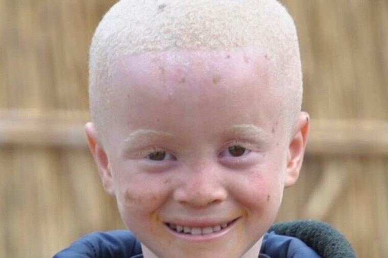 Madagascar : un enfant albinos de 2 ans sauvé après son enlèvement