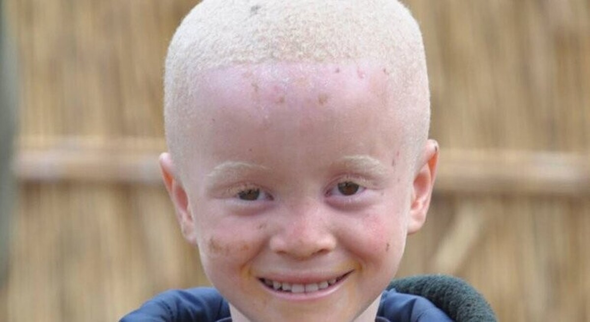 Madagascar: A 2-year-old albino child rescued after being kidnapped
