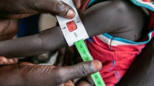 Somalie : la malnutrition infantile s’aggrave après les coupes dans l’aide internationale