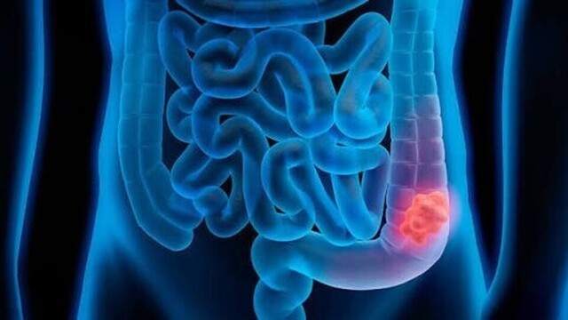 Cancer colorectal : ces symptômes que l’on ne devrait pas ignorer