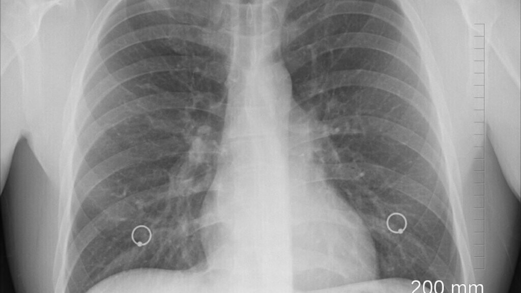 Embolie pulmonaire : ces symptômes soudains qui doivent immédiatement alerter