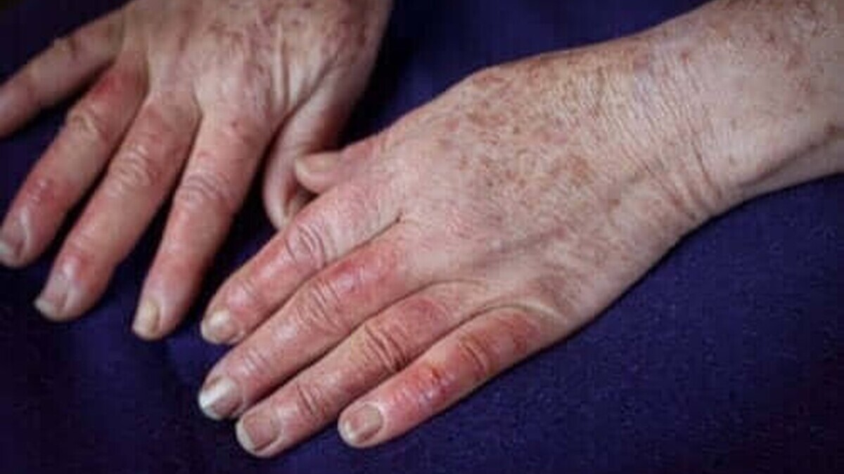 Maladie de Buerger : cette maladie rare des artères qui peut conduire à l'amputation Maladie de Buerger : cette maladie rare des artères qui peut conduire à l'amputation