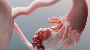 Cancer de l’ovaire : ces symptômes digestifs qui peuvent retarder le diagnostic