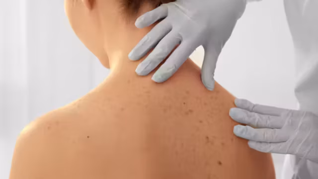Cancers de la peau : 3,5 millions de travailleurs exposés, l’Anses réclame une meilleure protection
