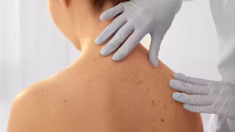 Cancers de la peau : 3,5 millions de travailleurs exposés, l’Anses réclame une meilleure protection