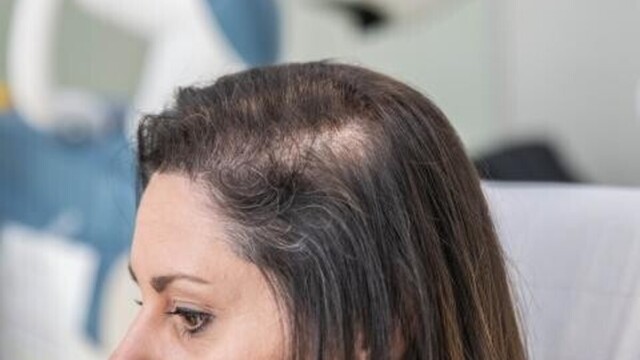 Chute de cheveux : pourquoi perd-on ses cheveux et comment ralentir le phénomène ? — photo