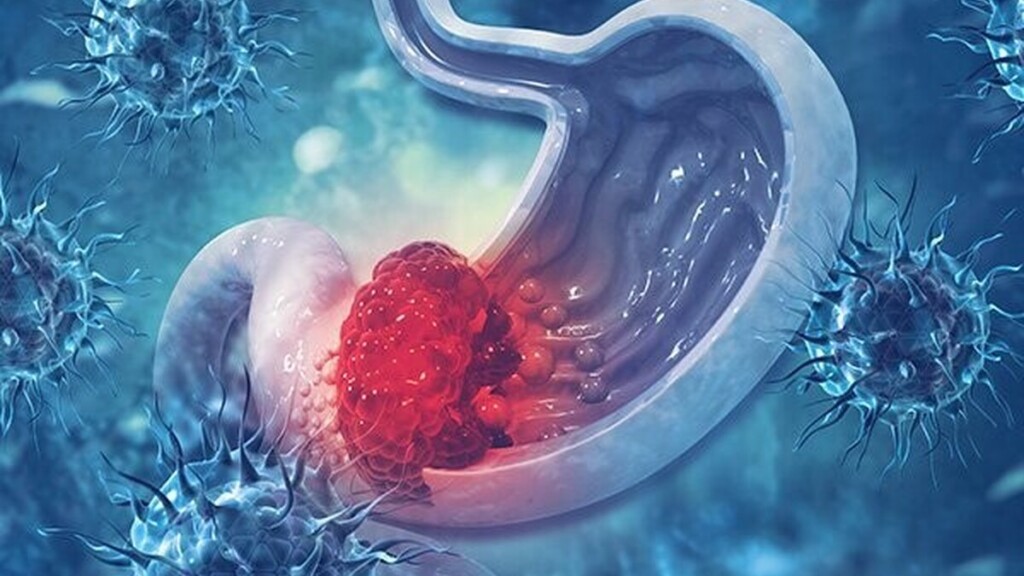 Cancer de l’estomac : ces troubles digestifs qui peuvent masquer une maladie grave
