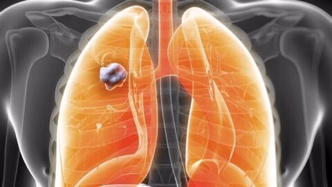 Cancer du poumon : ces symptômes qui peuvent passer inaperçus pendant des mois