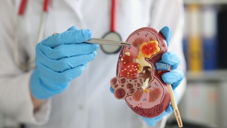 Cancer du rein : cette maladie qui peut se développer sans provoquer de douleur