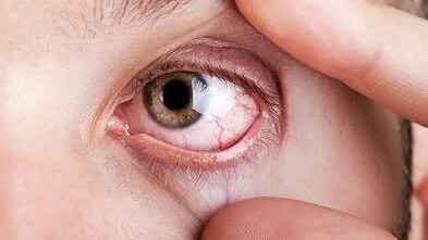 Syndrome de Sjögren : cette maladie auto-immune qui provoque une sécheresse des yeux et de la bouche
