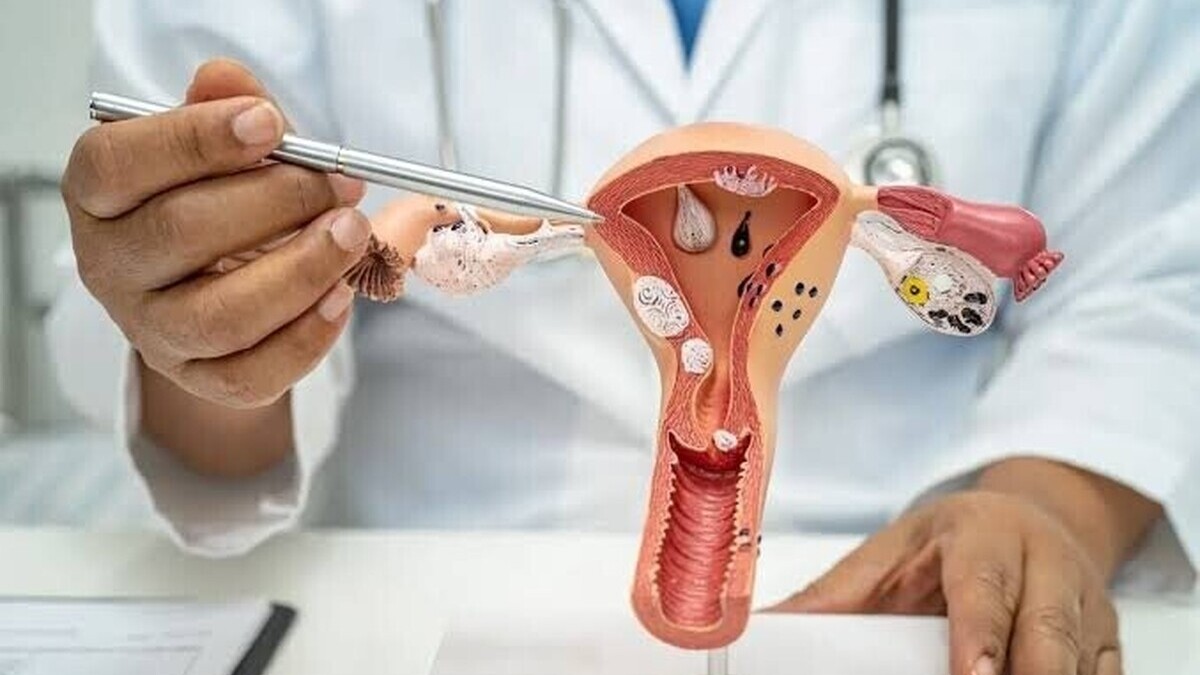 Endométrite : cette infection de l’utérus qui peut provoquer douleurs et fièvre