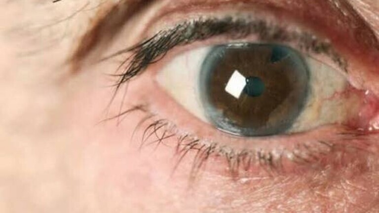 Glaucome : cette maladie des yeux qui peut rendre aveugle sans provoquer de douleur