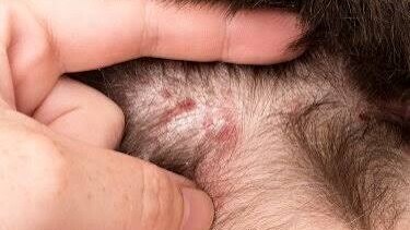 Eczéma du cuir chevelu : pourquoi la tête démange et comment soulager les irritations