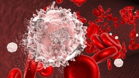 Leucémie : quels sont les premiers symptômes de ce cancer du sang ?