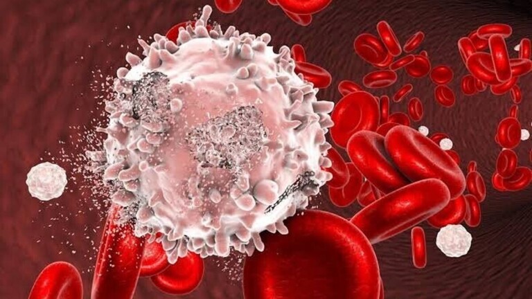 Leucémie : quels sont les premiers symptômes de ce cancer du sang ?