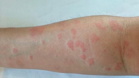Lupus : cette maladie auto-immune qui peut toucher la peau, les articulations et les reins