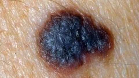 Mélanome : comment reconnaître un grain de beauté qui doit inquiéter ?
