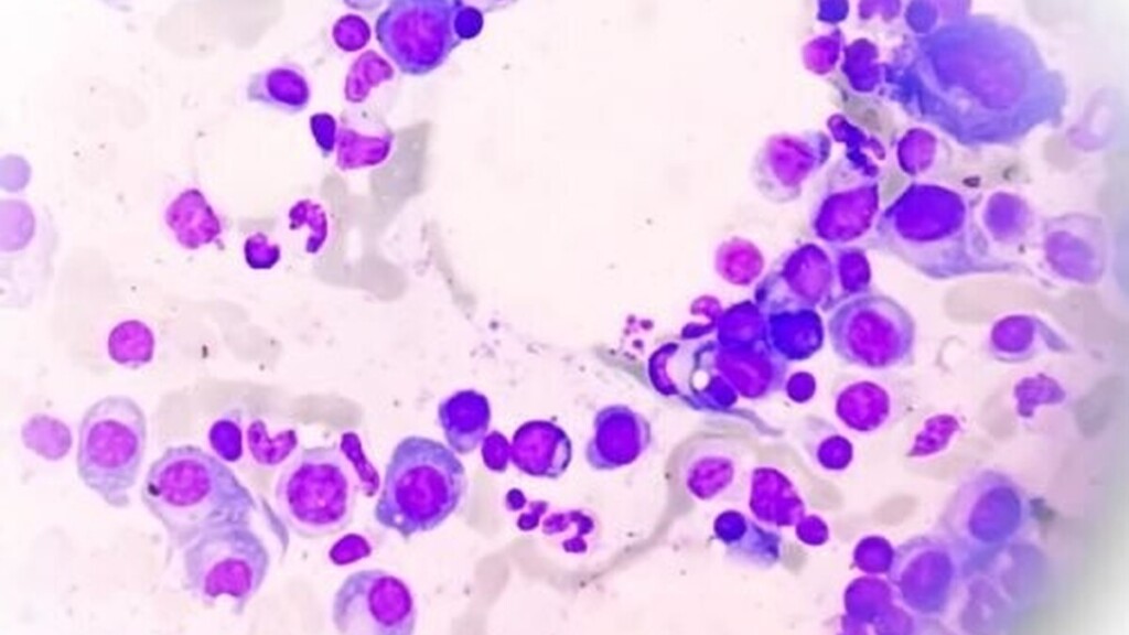 Myélome multiple : ce cancer du sang qui peut se révéler par des douleurs dans le dos