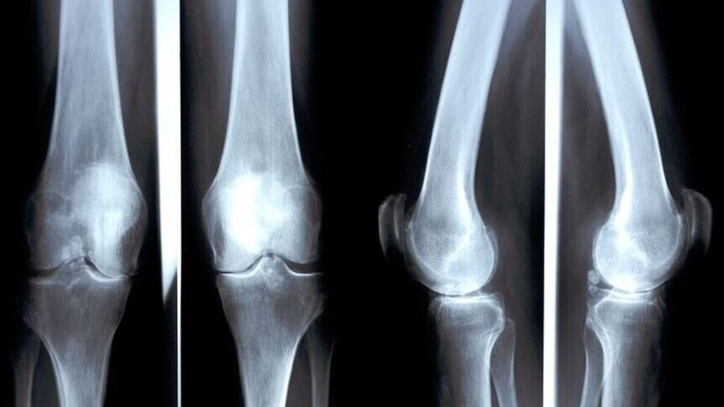 Ostéoporose : cette maladie silencieuse qui peut provoquer des fractures sans prévenir