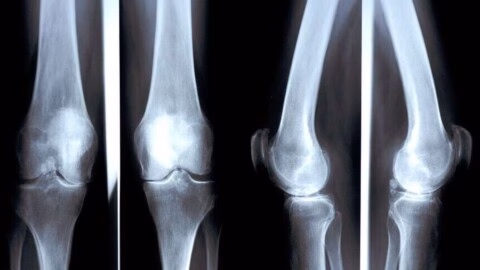 Ostéoporose : cette maladie silencieuse qui peut provoquer des fractures sans prévenir