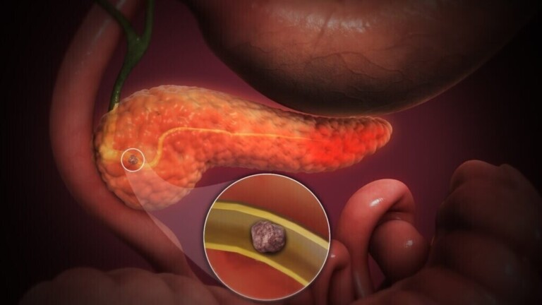 Pancréatite aiguë : cette inflammation du pancréas qui peut provoquer des douleurs abdominales violentes