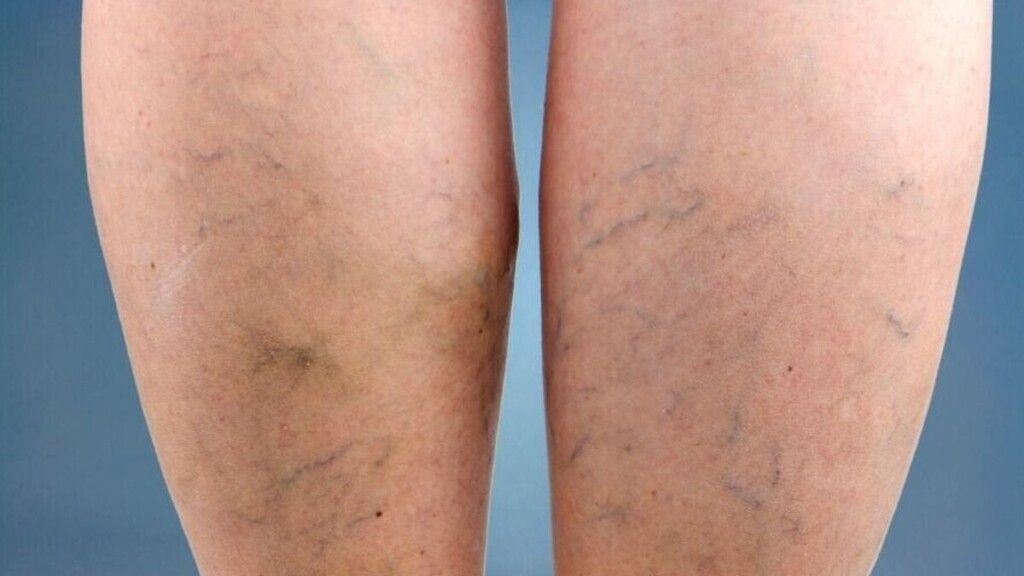 Phlébite : ces symptômes dans la jambe qui peuvent annoncer une complication grave