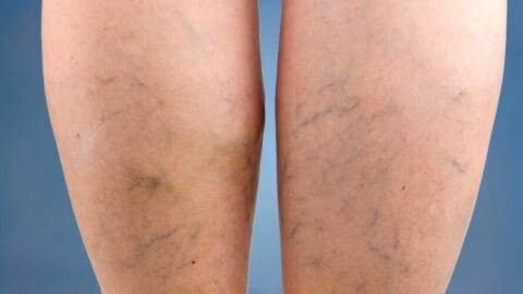 Phlébite : ces symptômes dans la jambe qui peuvent annoncer une complication grave