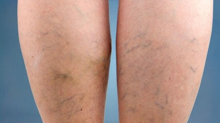 Phlébite : ces symptômes dans la jambe qui peuvent annoncer une complication grave
