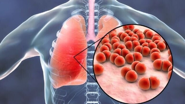 Pneumonie : quand une infection des poumons peut devenir une urgence médicale