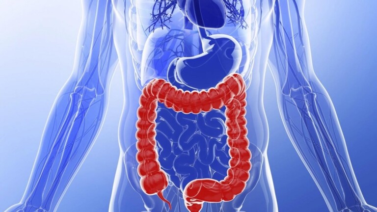 Rectocolite hémorragique : quand des diarrhées sanglantes révèlent une maladie chronique de l’intestin