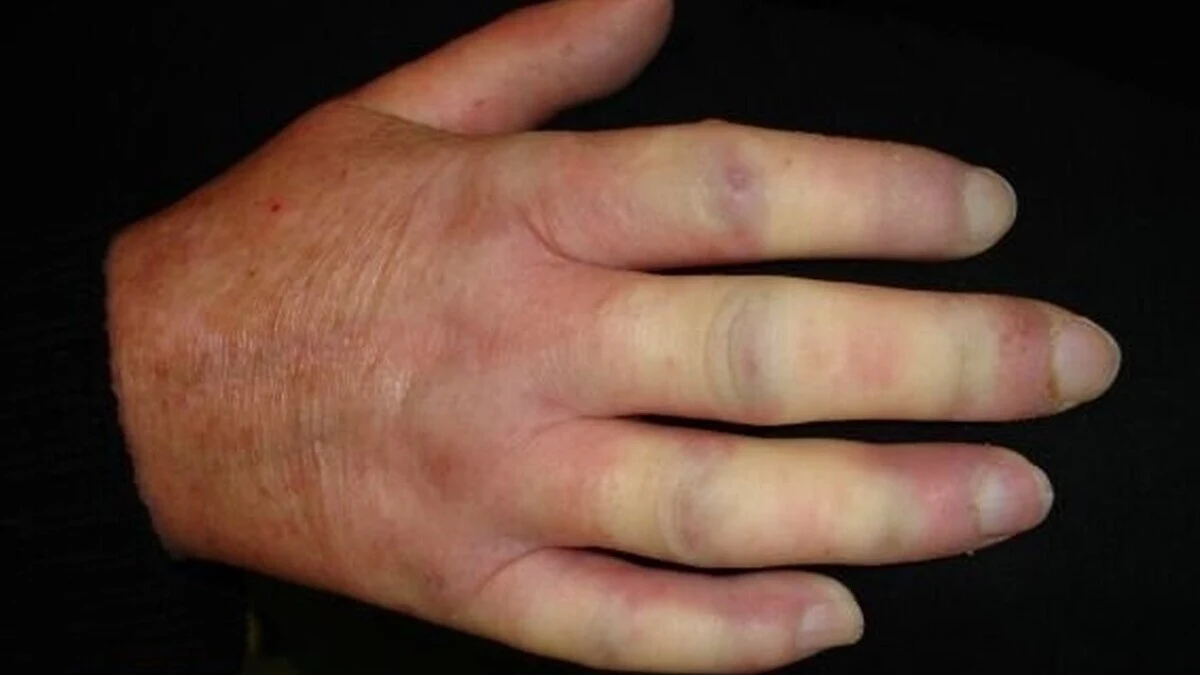 Sclérodermie : quand la peau se durcit et qu’une maladie auto-immune attaque l’organisme