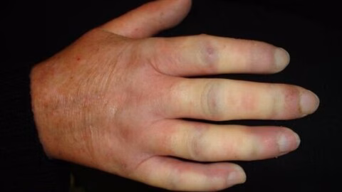 Sclérodermie : quand la peau se durcit et qu’une maladie auto-immune attaque l’organisme